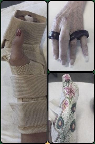 Picture of Splinting Bootcamp